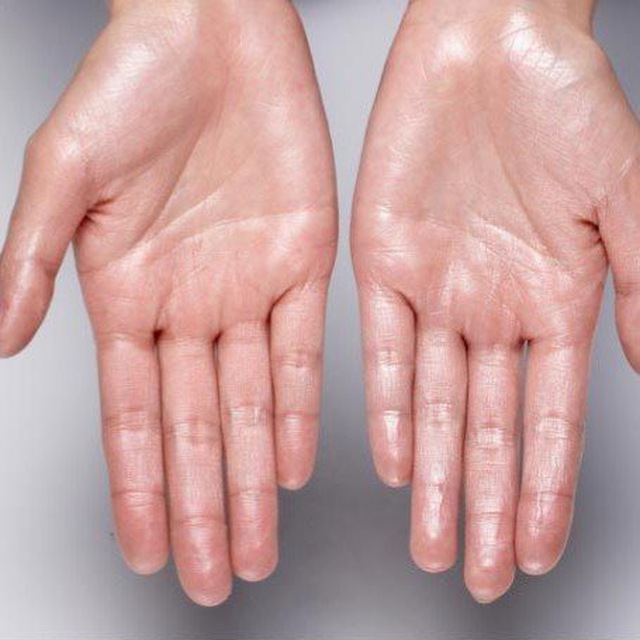Hiperhidrosis 🇪🇦 avatar